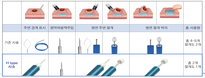 파인메딕스 클리어컷 나이프 'H타입 나이프' 시술 관련 내용. H타입은 2018년 파인메딕스와 아산병원 의료진이 공동 개발해 세계 최초로 선보인 하이브리드형 제품. ESD 시술 시 병변 형태나 시술자에 따라 I형 타입과 O형 타입의 나이프를 개별로 사용하나, 이를 가변형으로 하나의 나이프로 구현해 시술자의 편의성을 높이고 시술 시간을 단축한 게 특징. /사진제공=파인메딕스
