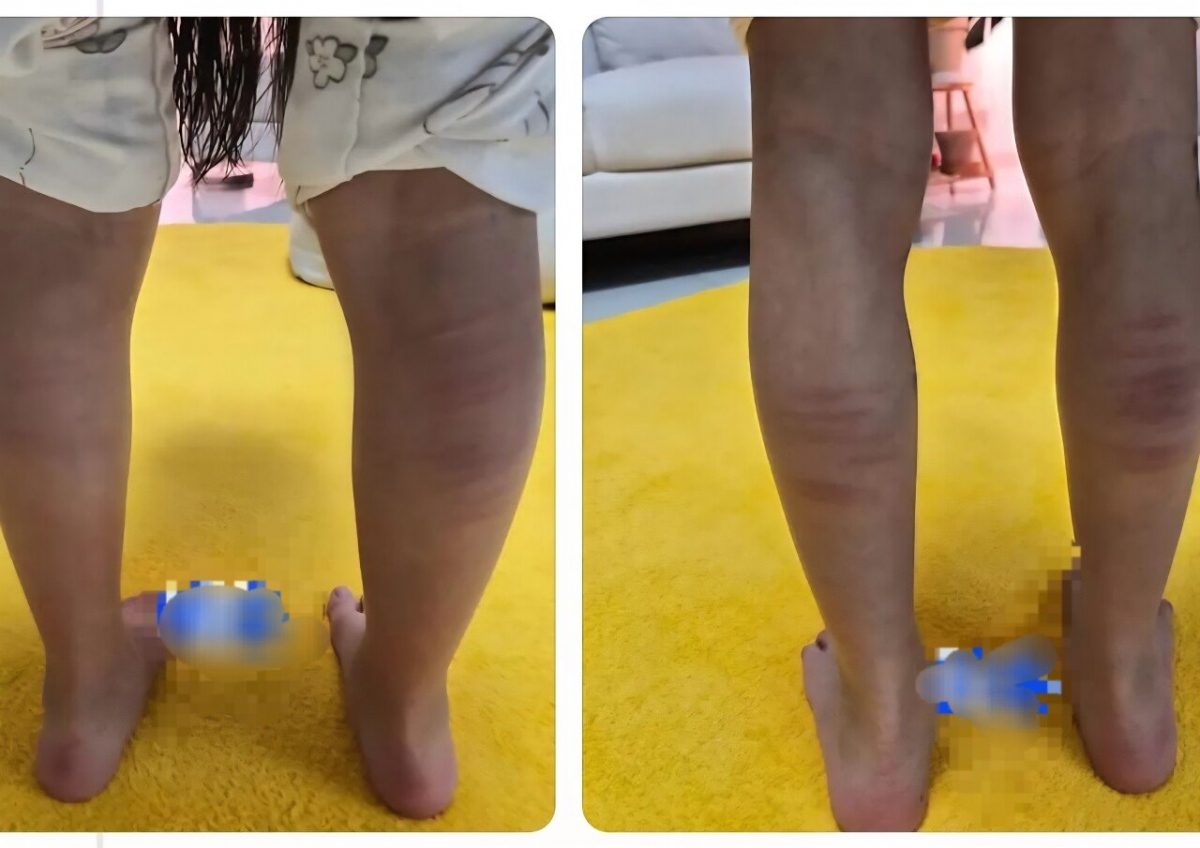 작성자는 종아리를 확대한 사진에 아이들 이름까지 적어놨다. /사진=스레드 캡처