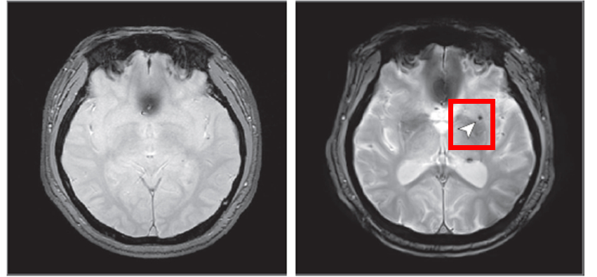 중등도 이상의 심한 폐쇄성 수면무호흡증이 있는 사람은 수면무호흡증이 없는 사람에 비해 뇌 미세출혈이 발생할 위험이 약 2.14배 증가했다. 사진은 8년 후 뇌 미세출혈이 발생한 뇌영상 이미지(사진 오른쪽)./사진=질병관리청