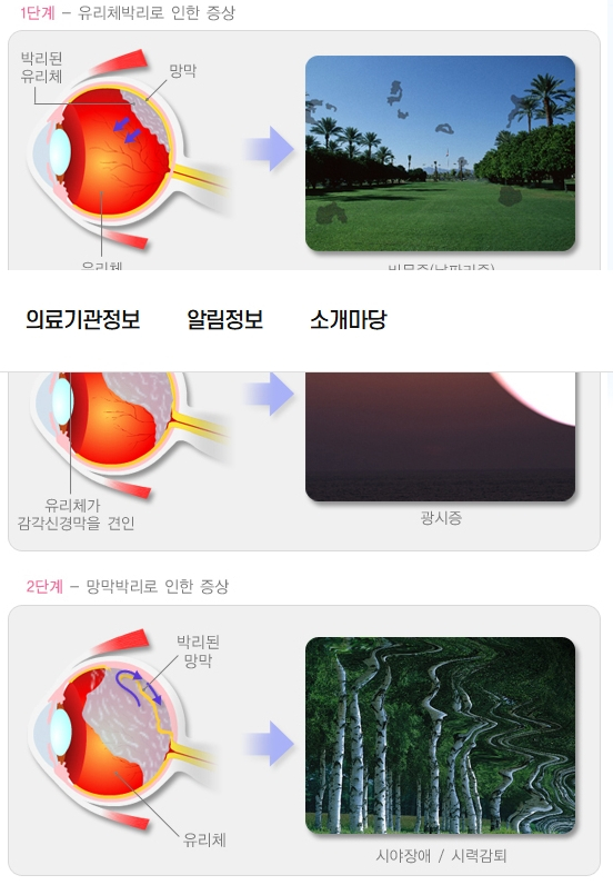 망막박리의 단계별 증상. /자료=국민건강정보포털