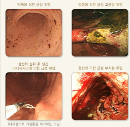 급성 위염의 다양한 위내시경 소견. /자료=국가건강정보포털