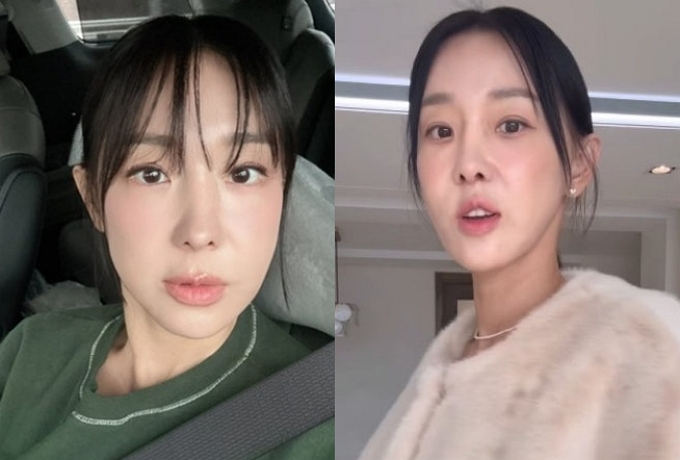 가수 겸 방송인 이지혜. 인중축소술을 받기 전과 후 /사진=이지혜 인스타그램 갈무리