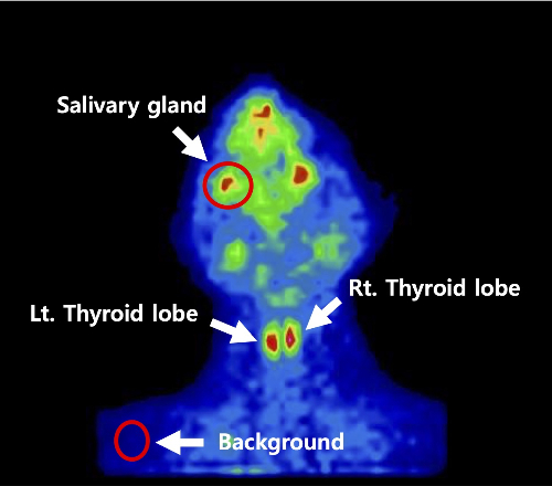 테크네키티를 투여한 뒤 단일광자방출단층촬영(SPECT)로 촬영한 영상 사진 /사진=한국원자력연구원