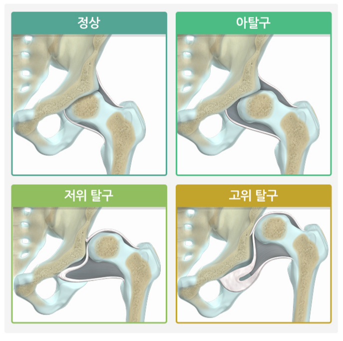 고관절 이형성증의 종류. /자료=국가건강정보포털