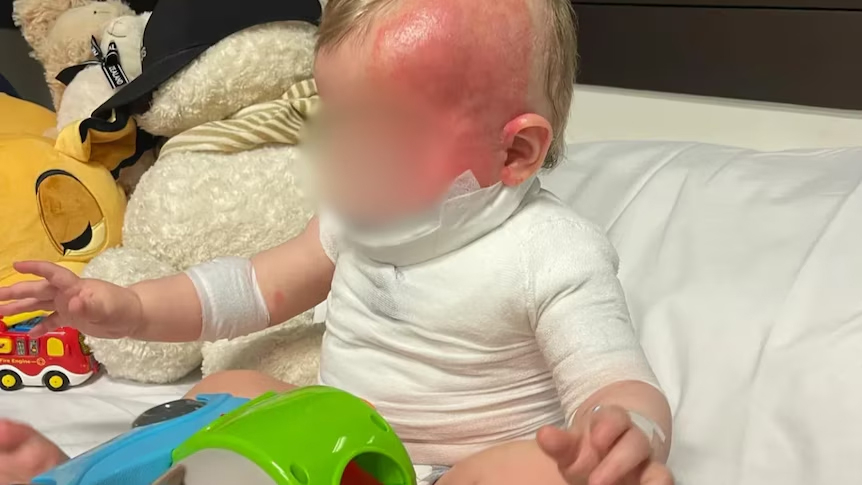 2024년 9월 호주 퀸즐랜드주 브리즈번의 핸론 공원에서 가족들과 피크닉을 즐기다 한 중국인 남성이 부은 뜨거운 커피로 화상을 입은 아기의 모습. 사진은 아기 가족이 호주 언론에 제공한 사진. /사진=호주 공영방송 ABC