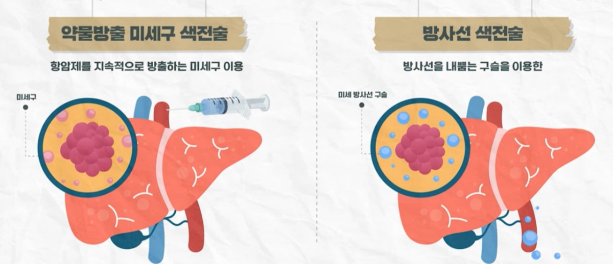 간암 최신 치료법으로 항암제가 담긴 작은 구슬을 주입하는 약물방출 미세구 색전술, 방사선을 내뿜는 작은 구슬을 이용한 방사선 색전술이 도입됐다. 부작용을 줄이고 암세포를 더 정교하게 공격할 수 있다. /자료=서울대병원