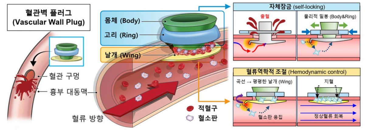연구팀이 개발한 혈관벽플러그 개요. /사진제공=세브란스병원
