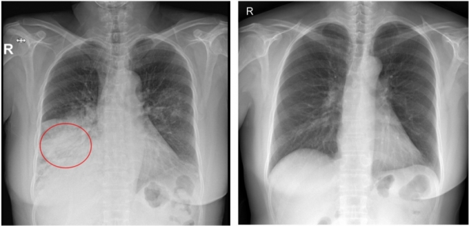 폐렴 환자(왼쪽)와 건강한 성인의 흉부 엑스레이 사진 비교. 환자 사진 중 빨간 동그라미 속 희뿌연 부분이 폐렴 우하엽(폐의 오른쪽 아래)병변이다. /사진=서울성모병원   