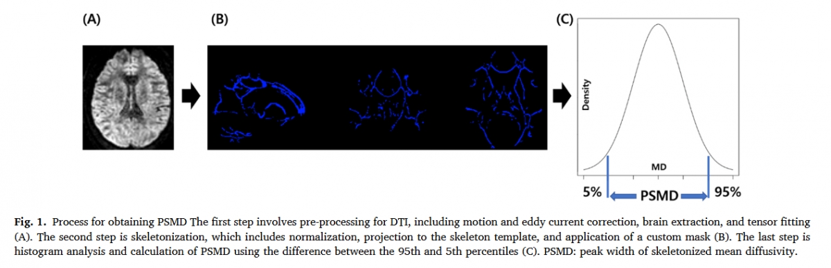 PSMD 산출 과정을 보여주는 이미지. 뇌 확산텐서영상(DTI)에서 주요 백질 신경섬유만 추출한 뒤, 확산도 분포의 상위 95%와 하위 5% 값의 차이를 계산해 PSMD를 산출한다. PSMD 값이 클수록 뇌 백질의 미세구조 손상이 큰 것으로 해석된다. /사진제공=해운대백병원
