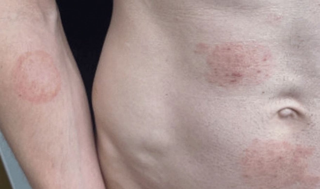 곰팡이균의 일종인 ‘트리코피톤 멘타그로피테스 7형’(TMVII)가 성관계를 통해 전파되는 것으로 확인됐다. /사진=미국 질병통제예방센터(CDC)