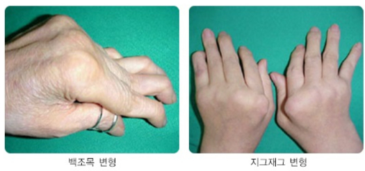 류마티스관절염 환자의 손목·손가락 관절이 변형된 모습. /자료=국가건강정보포털