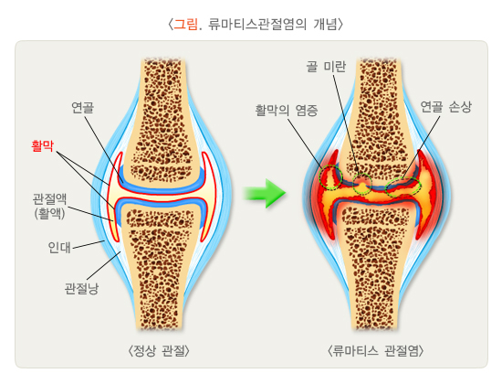 /자료=국가건강정보포털