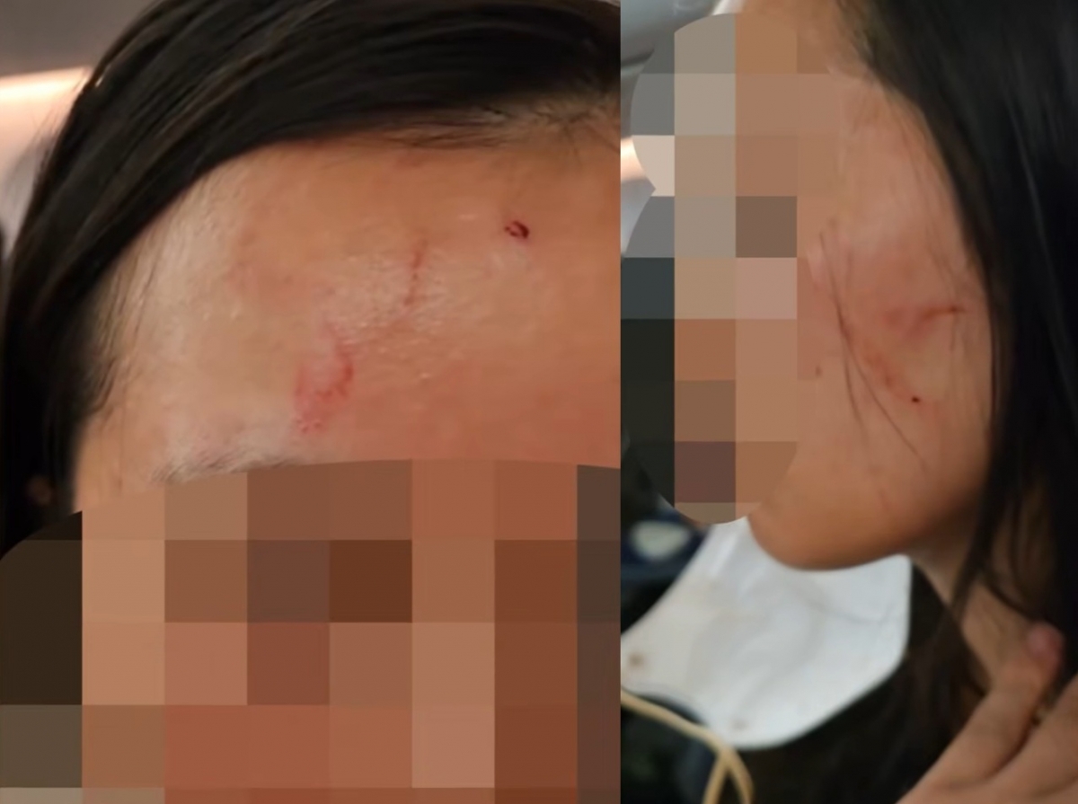 미국 패키지여행에서 만난 여성에게 폭행당한 피해자. /사진=JTBC '사건반장' 방송화면 갈무리