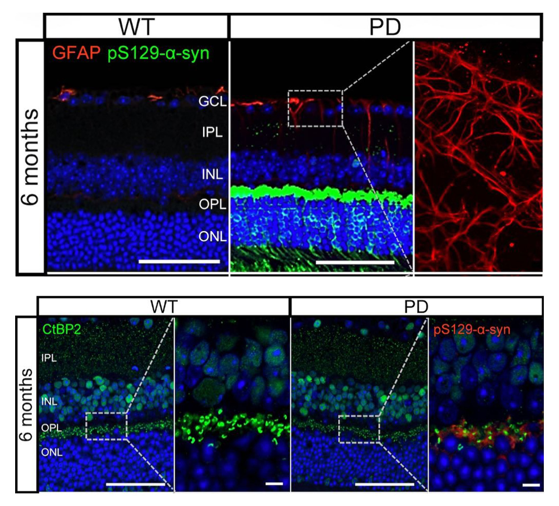 용인세브란스병원 안과 연구팀이 눈 망막 변화 통해 파킨슨병을 조기 진단할 단서를 규명했다. /사진=해당 연구팀 