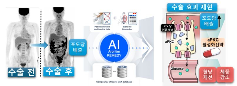 비만대사 수술 후 혈당 개선의 주요 기전으로 제시된 장내 포도당 배출현상을 기반으로, 인공지능(AI) 기반 신약 개발 플랫폼을 통해 핵심 분자 기전인 aPKC/GLUT1 신호축 및 해당 기전을 조절할 수 있는 약물 후보를 도출했다. /사진제공=세브란스병원