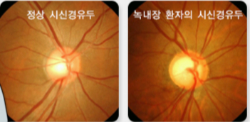/자료=국가건강정보포털