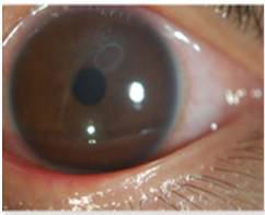 알레르기 결막염으로 생긴 표층각막궤양. /사진=국가건강정보포털