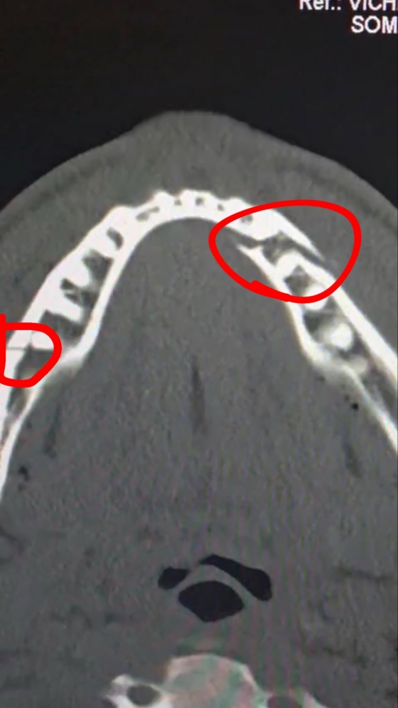 제이크 폴이 조슈아와 경기 후 공개한 턱뼈 골절 엑스레이. /사진=제이크 폴 개인 사회관계망서비스(SNS)