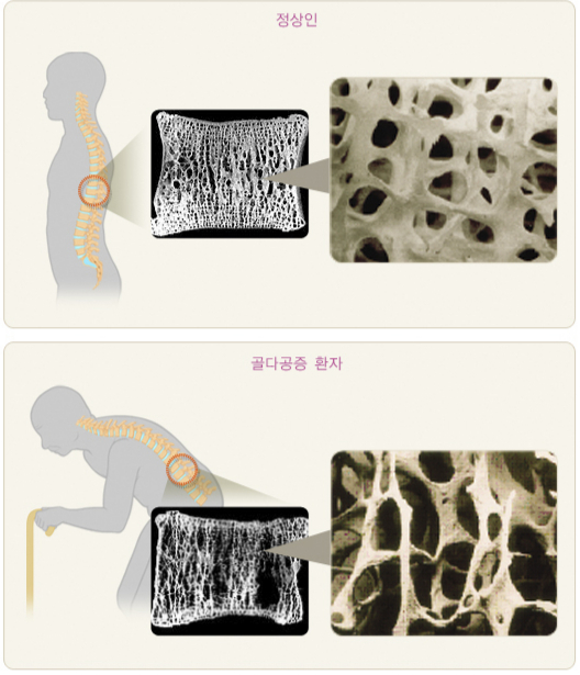 정상인(위)과 골다공증 환자(아래)의 뼈. /자료=대한골대사학회