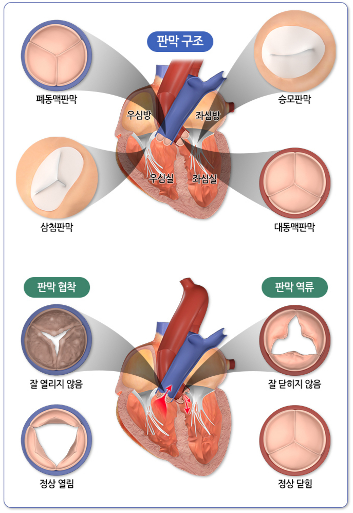 심장판막의 구조와 판막질환. /자료=국가건강정보포털