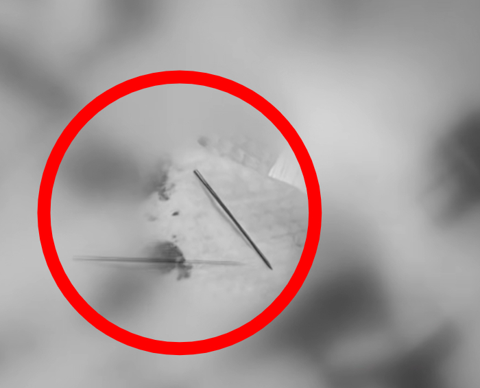 A씨 입천장을 뚫고 나온 철심. /사진=JTBC '사건반장'