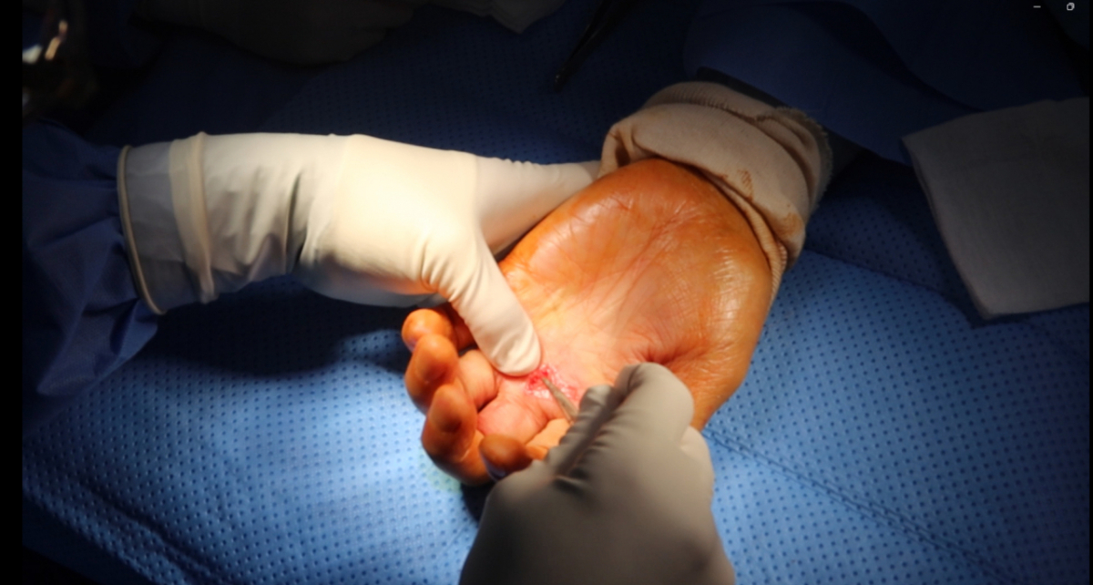 방아쇠수지 수부각성수술 장면./사진=연세스탠다정형외과