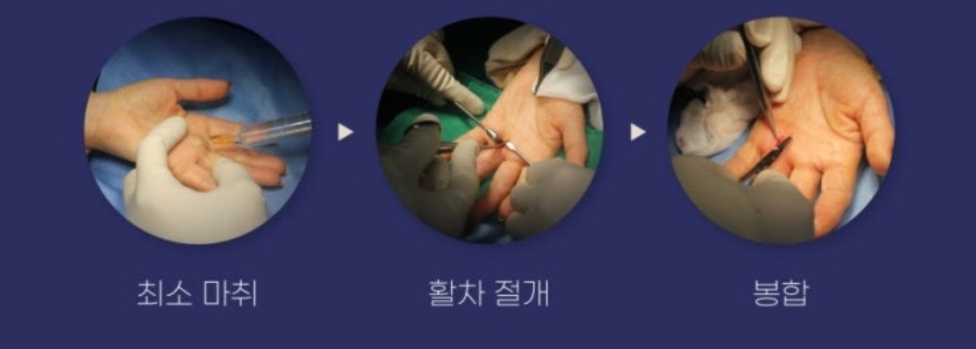  방아쇠수지 수부각성수술 과정./사진=연세스탠다정형외과 