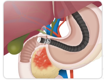 복부 초음파내시경으로 췌장을 살펴보는 모습. /자료=대한췌장담도학회 