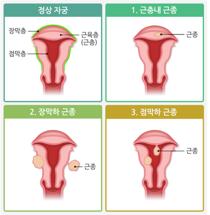 자궁근종의 종류. /자료=국가건강정보포털
