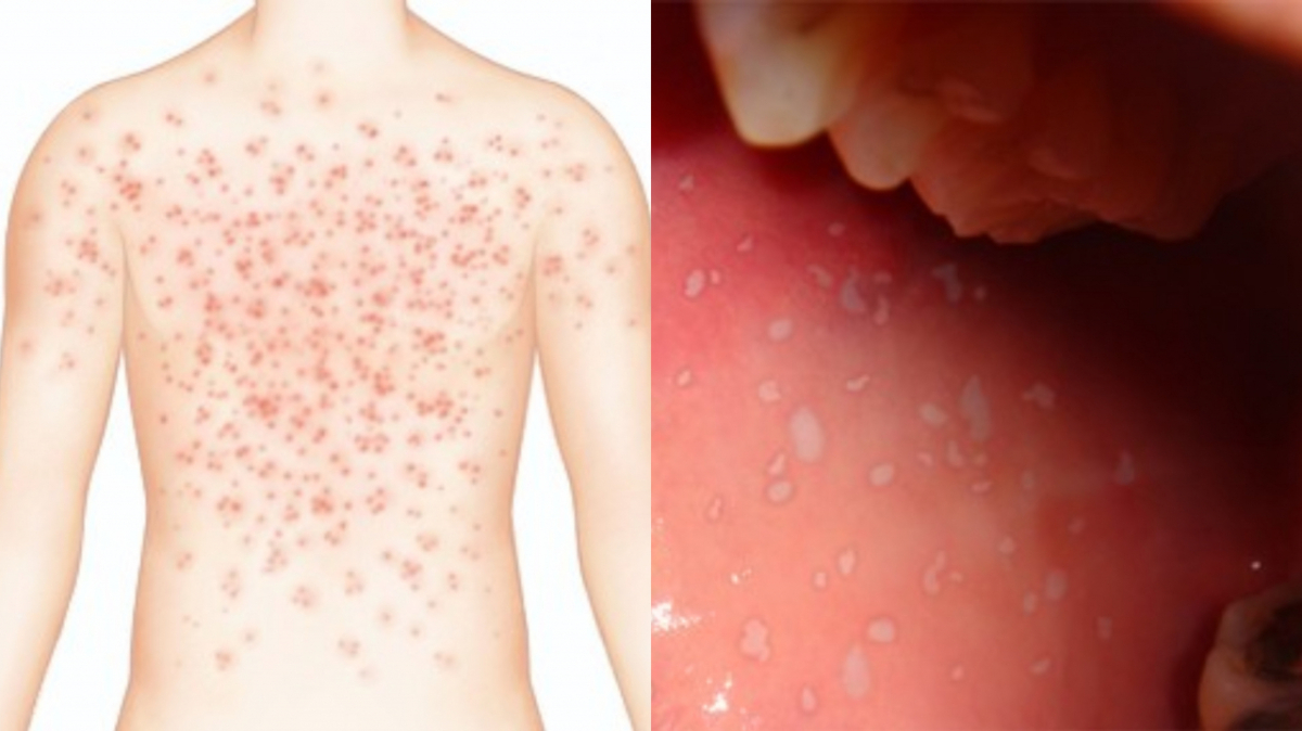 (왼쪽부터)홍역에서 나타나는 피부발진과 코플릭 반점. /사진=서울대학교병원 의학정보