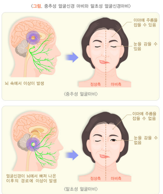 벨마비는 말초성 얼글마비의 대표적 질환이다. 중추성 얼굴마비와 달리 이마에 주름을 잡을 수 없고, 눈을 감을 수 없다. /자료=국가건강정보포털