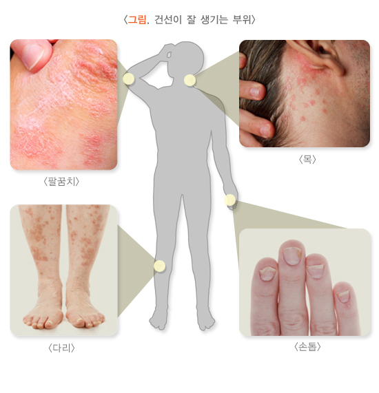 건선은 면역체계에 문제가 생겨 발생하는 '만성염증성' 질환이다. 피부가 붉어지는 '홍반'과 하얀 각질이 일어나는 증상 '인설', 피부가 두꺼워지는 '비후 등이 주증상이다. 두꺼워진 피부에 홍반과 인설이 동반하며 팔꿈치, 무릎, 엉덩이, 두피 등 자극을 많이 받는 부위에 나타난다. 보통 병변 경계가 뚜렷하고 좌우 대칭적으로 나타나는 양상을 보인다. /사진=질병관리청
