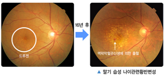 맥락막 신생활관이 출혈을 일으켜 실명을 유발하는 과정. /사진=국가건강정보포털