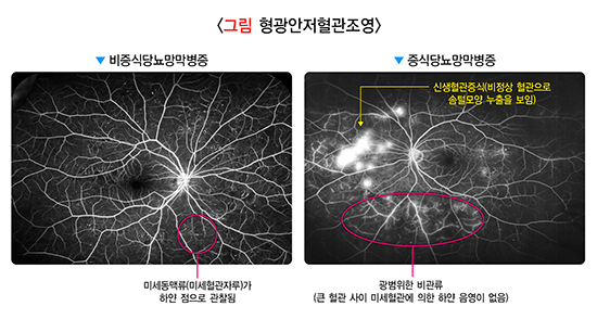 당뇨병 환자의 안저촬영 결과물. 비증식성 당뇨망막병증(왼쪽)과 증식성 당뇨망막병증(오른쪽)을 알 수 있다. /사진=국가건강정보포털  