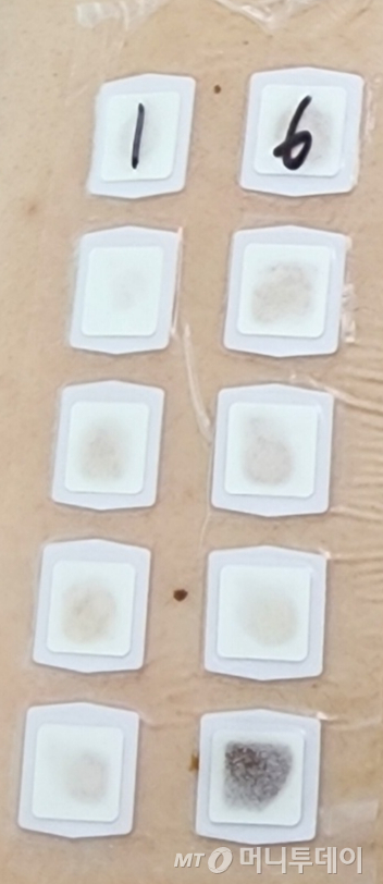 평소 가려움증이 있는 기자가 첩포검사를 받았다. 접촉성 알레르기 원인을 찾는 검사로, 피부 알레르기 유발 물질 42가지(기본검사 25가지, 화장품보습제 성분17가지)를 등에 붙인 채 4일 후 알레르기 반응이 나타나는지 확인하는 방식이다./사진=정심교 기자
