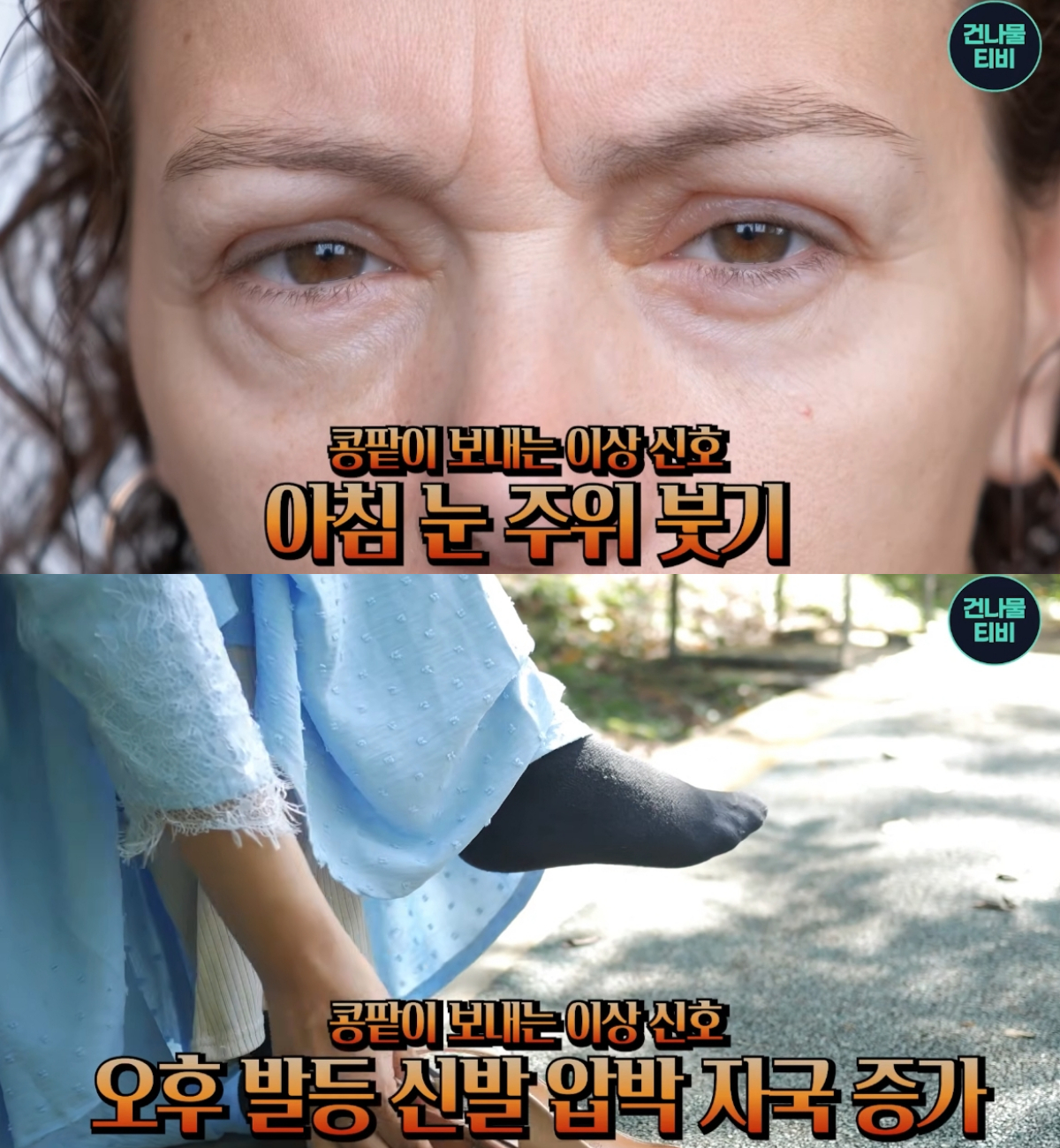 신장은 이상이 생겨도 뚜렷한 증상이 나타나지 않는 경우가 많아 질환을 뒤늦게 발견할 가능성이 높지만, 일상 속 신체 변화를 통해 이상 신호를 조기에 감지할 수 있다는 전문가 조언이 나왔다. /사진=유튜브 채널 '건나물TV' 캡처