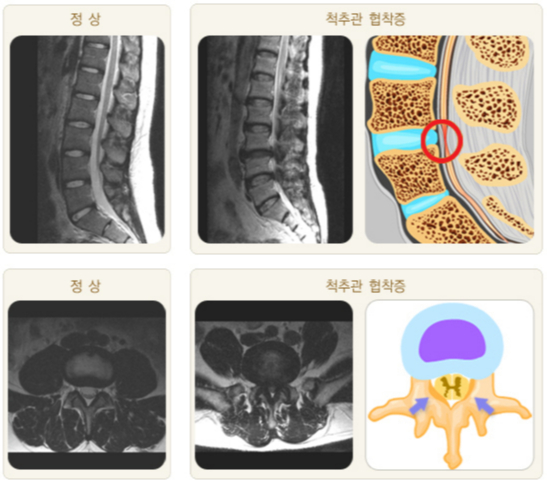 척추관협착증 환자의 허리(요추부)와 정상인의 MRI(자기공명영상) 검사 결과 비교. /자료=국가건강정보포털