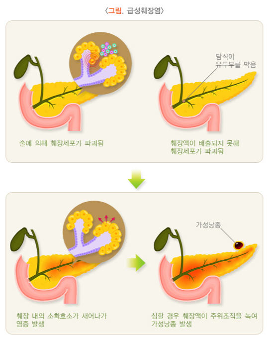급성 췌장염이 생기는 과정. /자료=국가건강정보포털