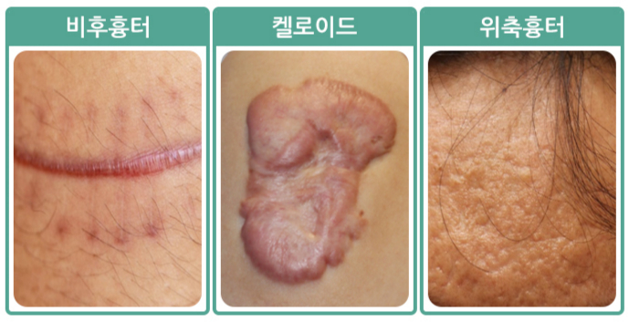 병적 흉터의 종류. /사진=국가건강정보포털