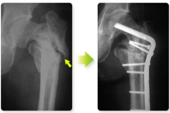 대퇴골 전자하부 골절 후 1년 넘는 치료에도 치유 과정이 정지(불유합)돼 뼈 이식과 금속판으로 치료한 환자의 병변 사진. 흡연은 골절 후 치유 과정을 방해하는 주원인이다. /사진=국가건강정보포털