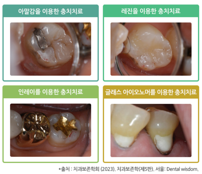 충치(치아우식증)를 치료하는 다양한 방법. /사진=치과보존학회