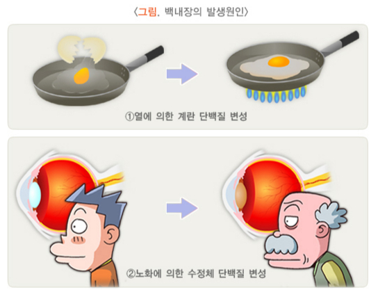 노화로 인한 백내장의 원인을 알기 쉽게 설명한 그림. /자료 =국가건강정보포털
