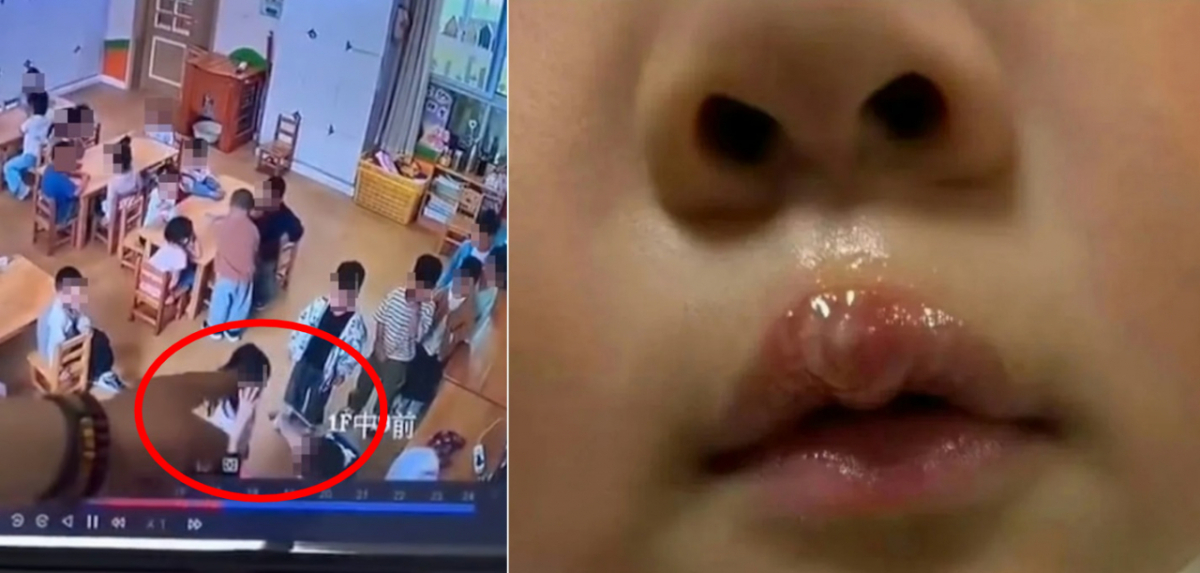 중국의 한 유치원에서 교사가 4세 여아 입술에 뜨거운 글루건을 쏴 화상 입힌 사건이 발생했다. 오른쪽 사진은 화상 입은 피해 아동의 입술 모습. /사진=홍콩 SCMP 갈무리