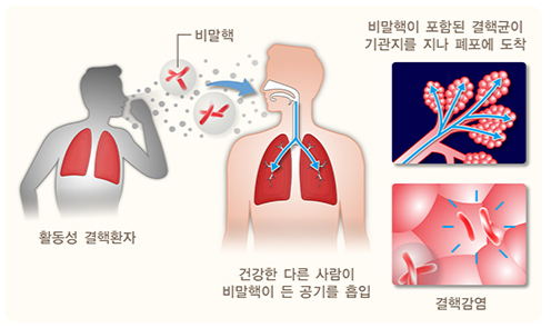 결핵의 전염 과정. /자료=국가건강정보포털