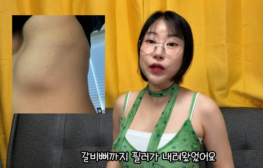 개그우먼 이세영이 가슴 성형 재수술 이유로 필러 부작용을 꼽았다. /사진=유튜브 영상 캡처