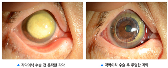 심하게 혼탁해진 각막(왼쪽)과 각막이식 받은 후. /자료=국가건강정보포털