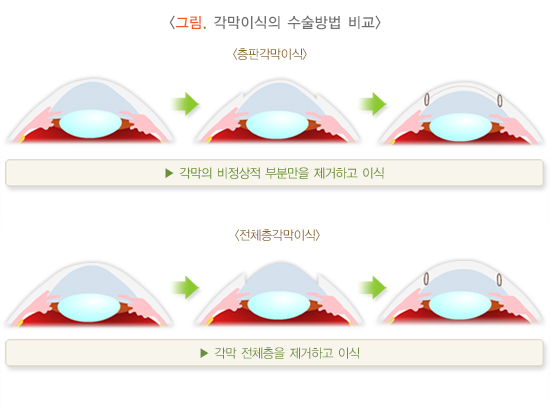 각막 일부만 잘라내는 부분층(층판) 각막이식(위), 각막 전체를 바꿔주는 전체층 각막이식(오른쪽) 비교 그림. /자료=국가건강정보포털