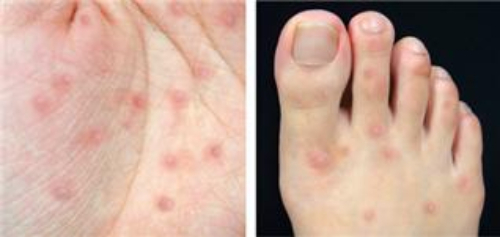 수족구병으로 손과 발에 발생하는 발진. /사진제공=서울대병원