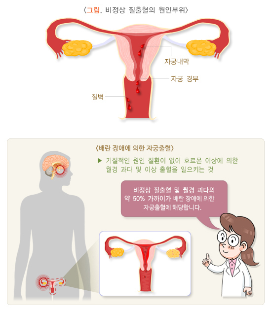 비정상 질 출혈의 원인 부위. /자료=국가건강정보포털