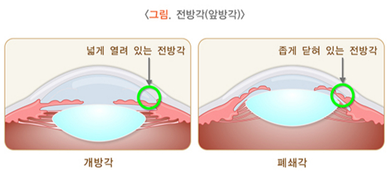 급성폐쇄각녹내장은 눈 속 액체인 '방수'가 빠져나가는 통로인 전방각이 갑자기 막히면서 안압이 급격히 상승하는 질환이다. /자료=국가건강정보포털